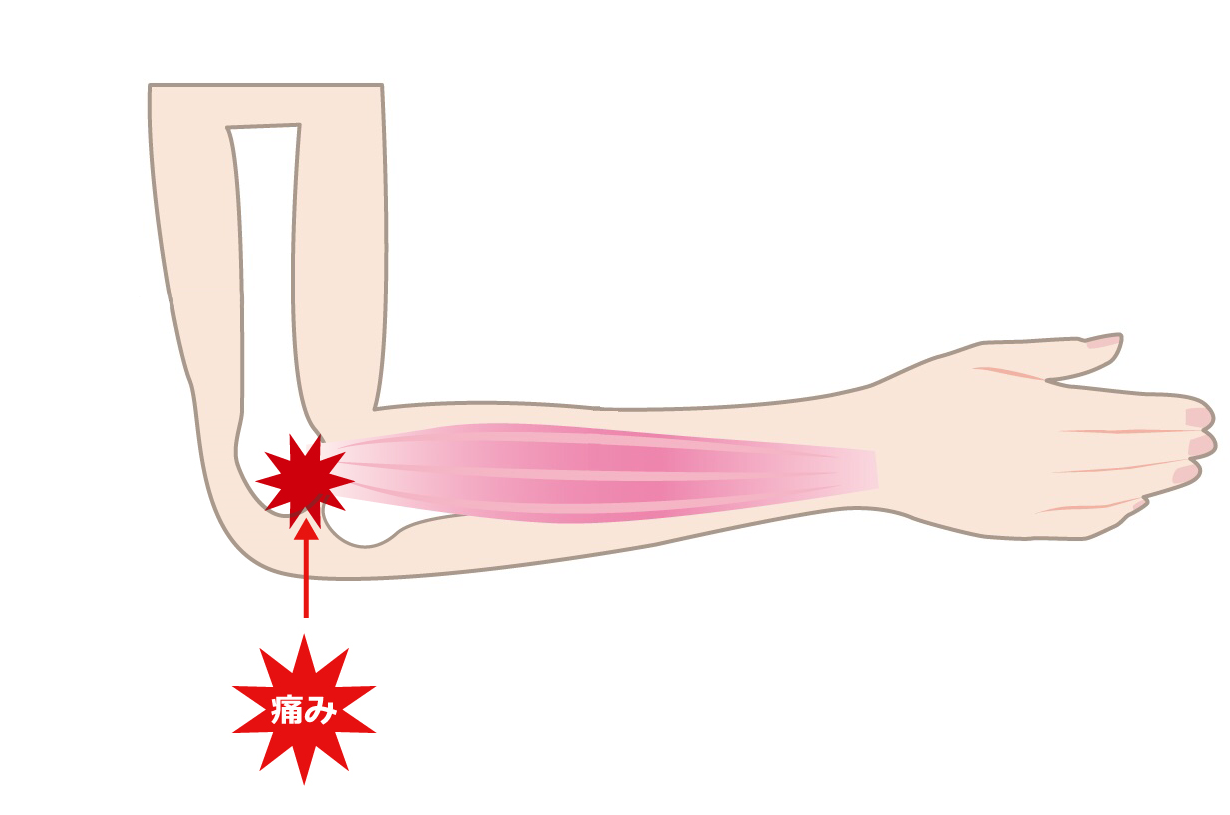 テニス肘（外側上顆炎）｜ダエンからマル Lab.（ラボラトリー）｜ダエンからマル施術院