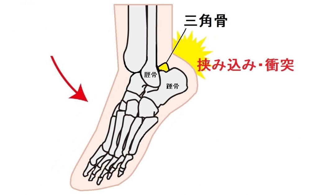 三角骨障害｜ダエンからマル Lab.（ラボラトリー）｜ダエンからマル施術院